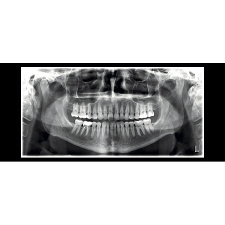 Planmeca ProMax 2D SCARA 2 - рентгеновская установка с цефалостатом